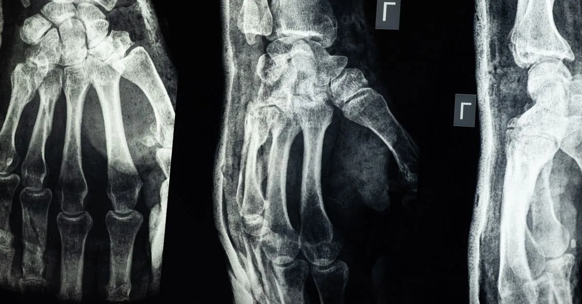 X-ray films of a hand and wrist, the kind of imaging an orthopedic surgeon reviews before treating a fracture.